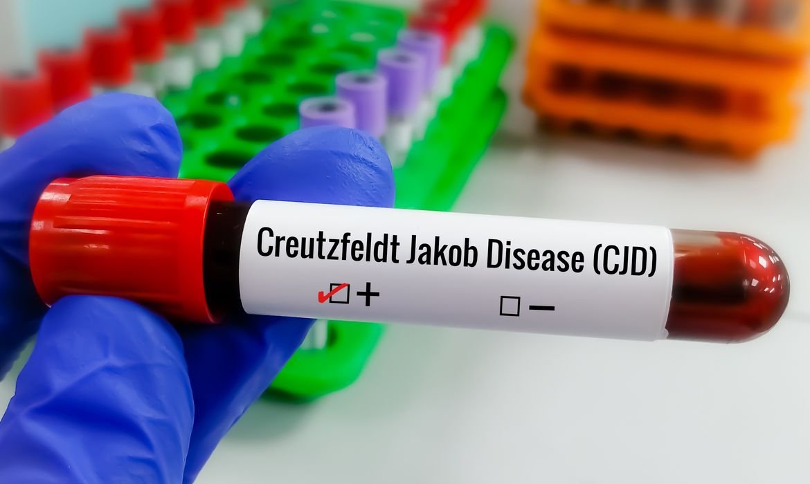 Brasil teve 547 casos confirmados de Creutzfeldt-Jakob